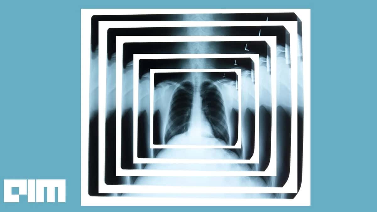 An AI Tool To Assess Severity Of COVID-19 Cases