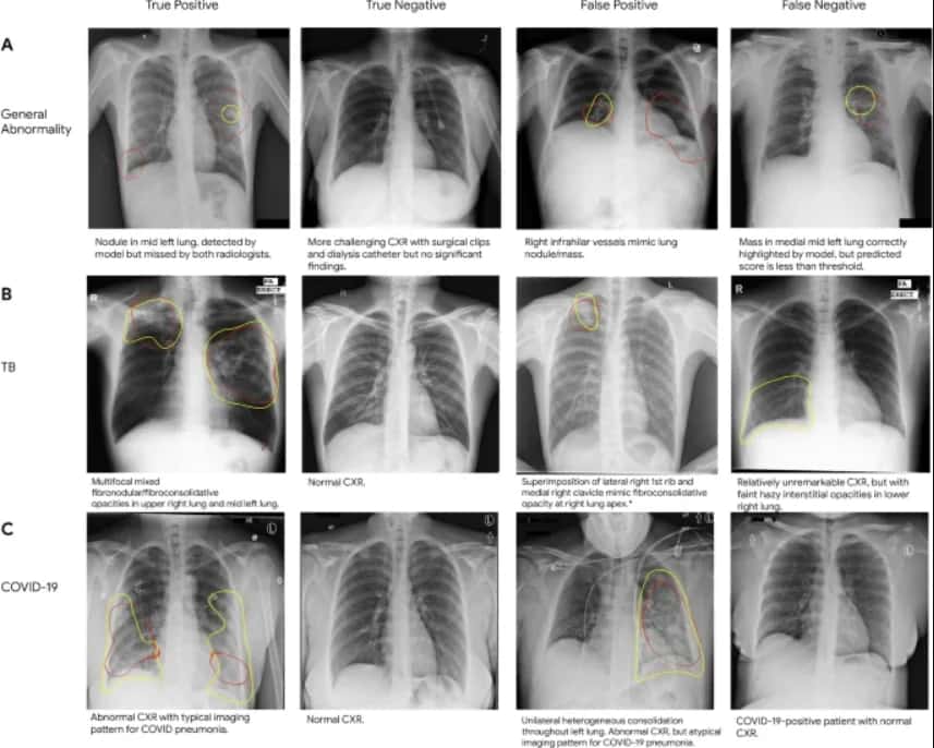 Googleâs New Deep Learning System To Distinguish Abnormal Chest Radiographs