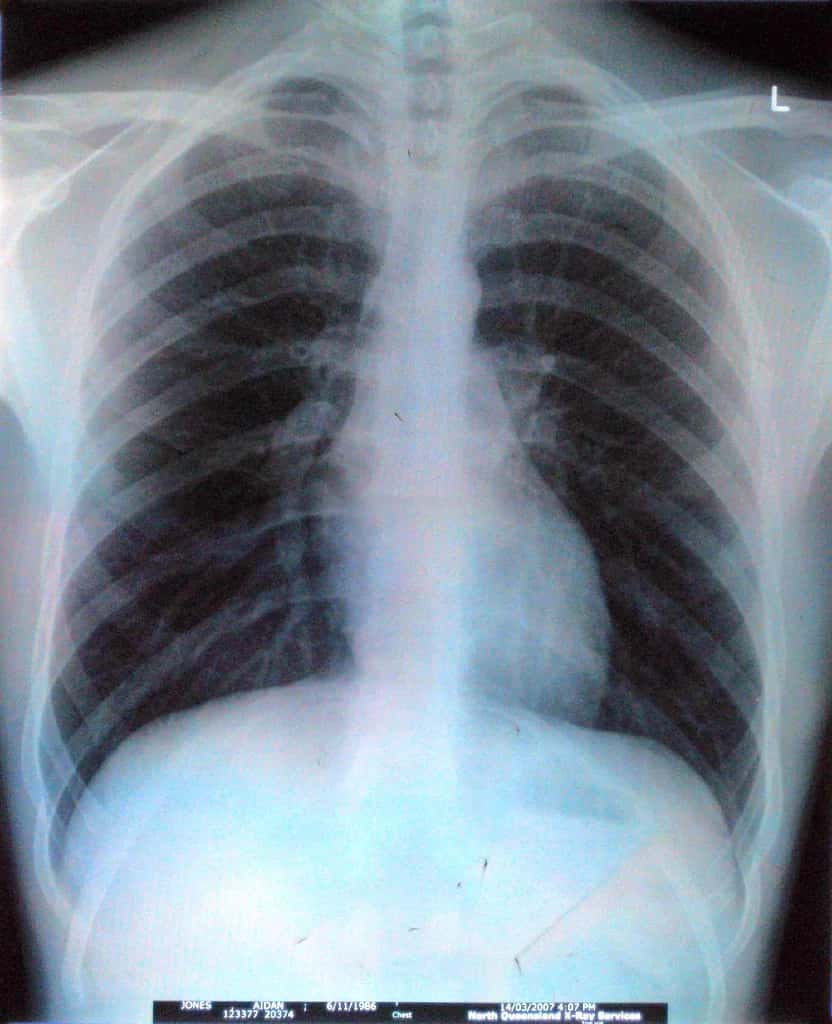 Researchers At IIT-Gandhinagar Develop AI-Based Tool To Detect COVID-19 With Chest X-Rays